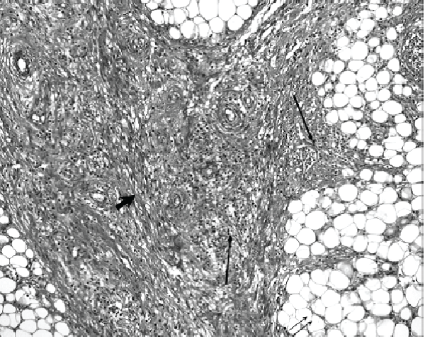 Fibroadipose