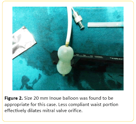 Challenges of Percutaneous Balloon Mitral Valvuloplasty in ...